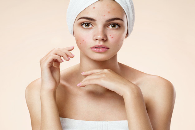 Best Solutions For Acne Problem in Skin - Top Acne Treatments Review