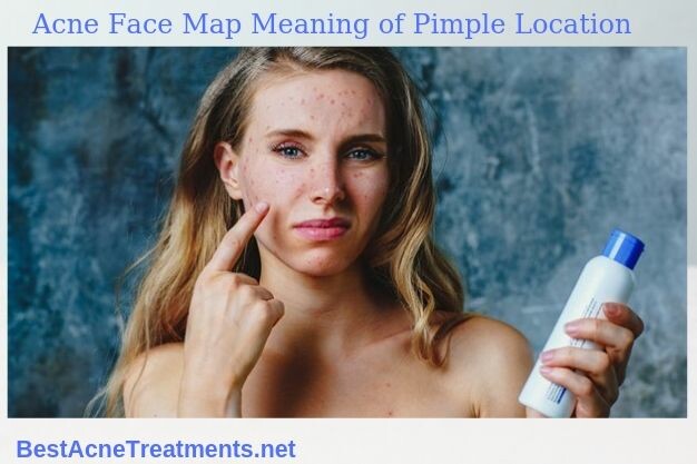 Acne Face Map, Meaning of Pimple Location